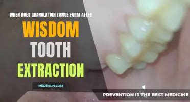 does maxicare cover wisdom tooth extraction